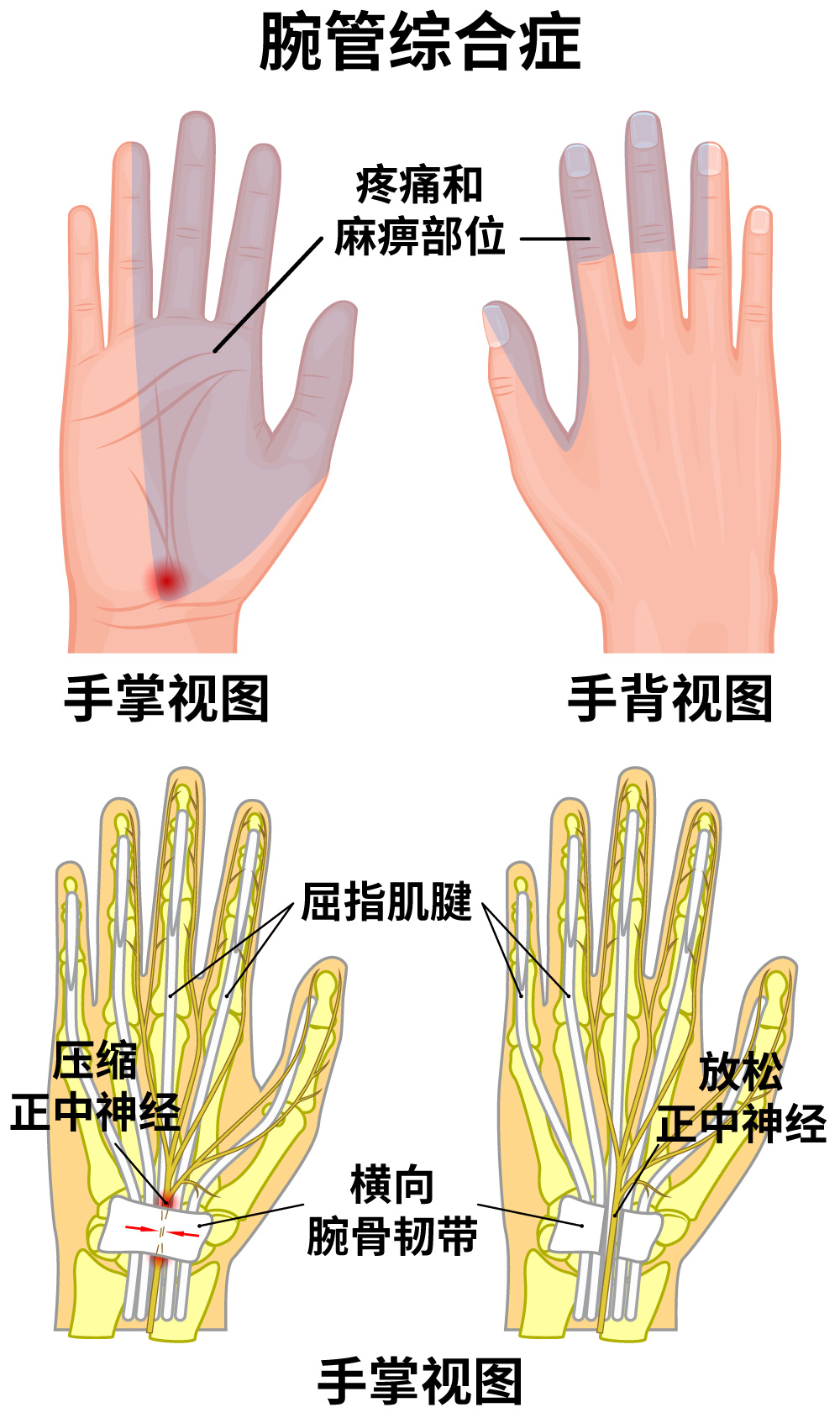 明确的腕管综合征，麻痹和瘫痪