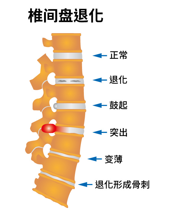 颈肩椎间盘退变包括正常椎间盘，退行性椎间盘，膨出椎间盘，椎间盘突出，变薄椎间盘和具有骨赘形成的椎间盘退变。