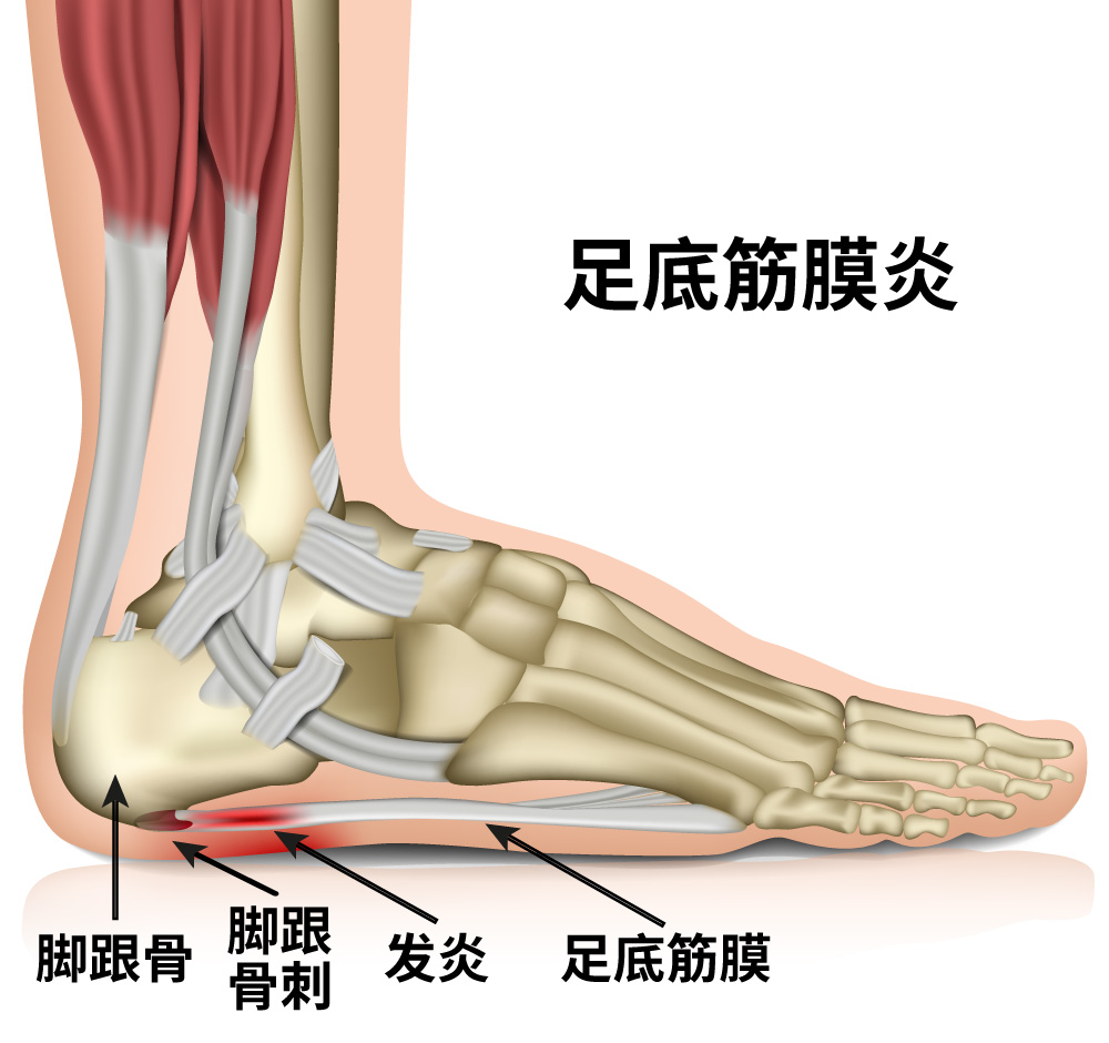 足底筋膜炎，发炎，脚跟骨，脚跟骨刺